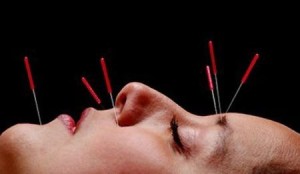 facial-acupuncture